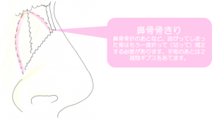 外鼻変形の治療 東京大学大学院医学系研究科 形成外科学分野